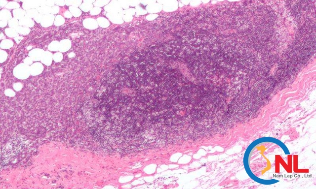 Hình ảnh hiển vi cho thấy hạch bạch huyết bị ung thư vú động mạch xâm chiếm, phần mở rộng của khối u đã vượt ra ngoài hạch bạch huyết (Ảnh: Nephron)